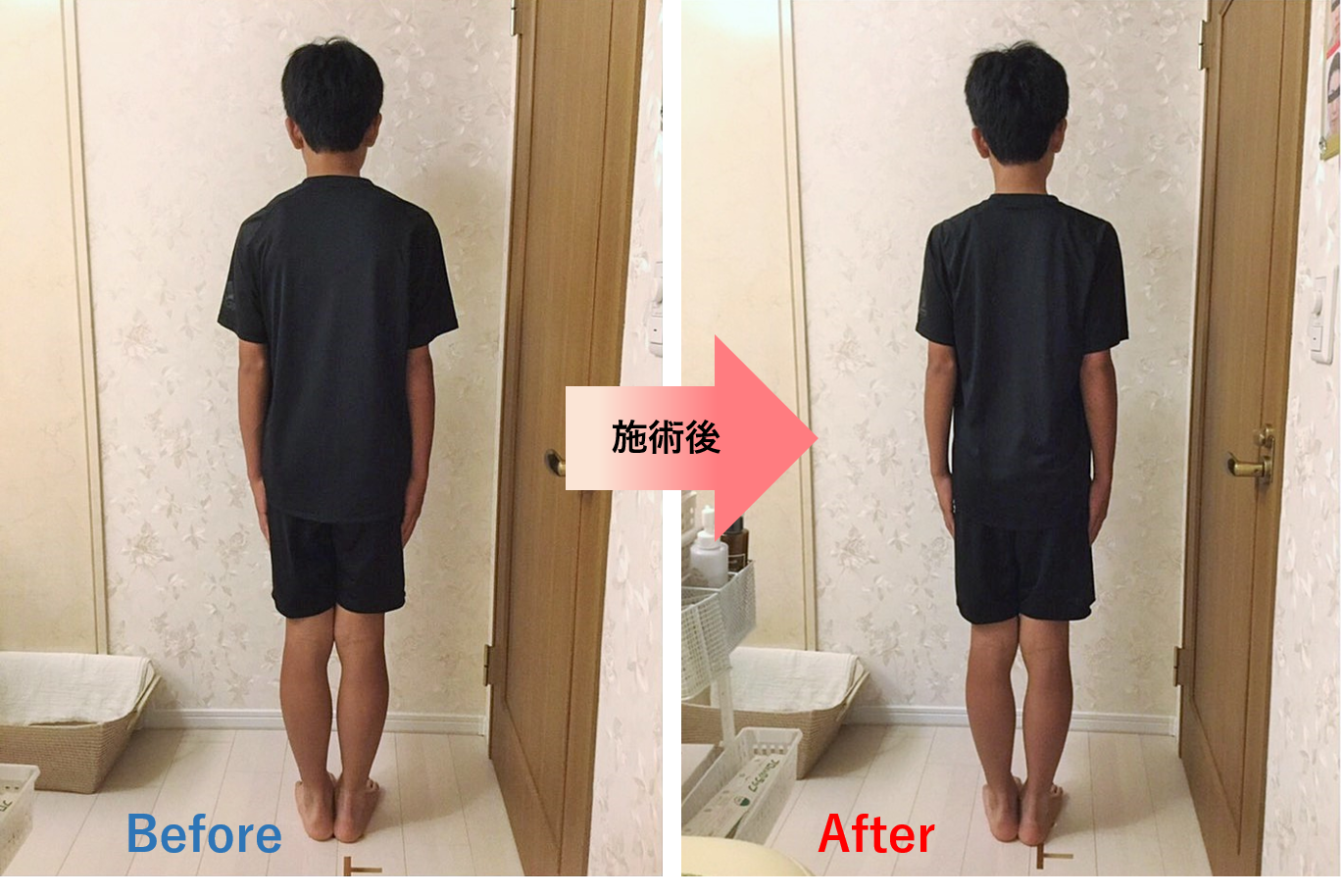 肩の位置が変わり胸が開いた