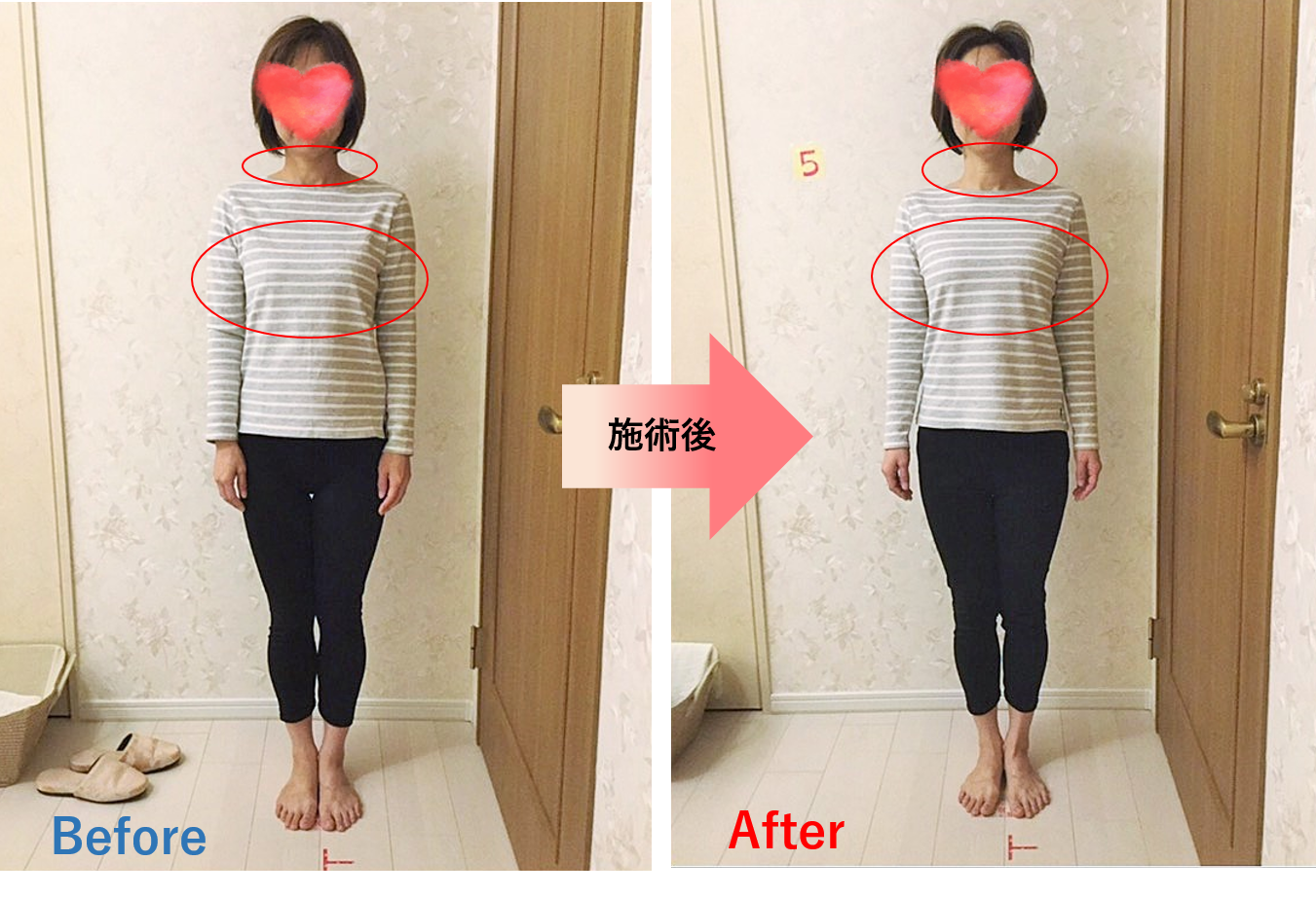 バランス骨矯正　ビフォーアフター